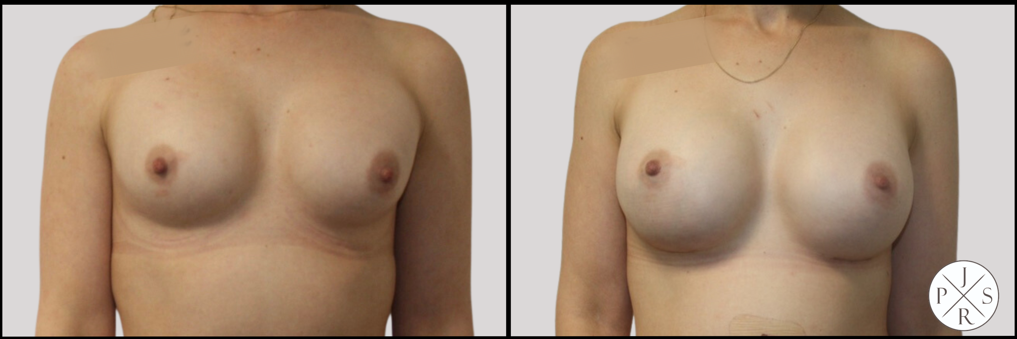 Breast Revision Before & After Image